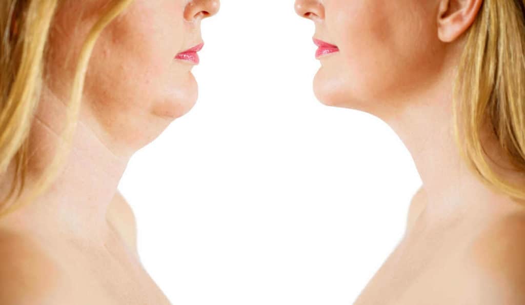 Double Chin treatment Lewes before and after results