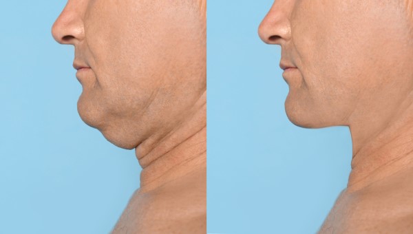 Which Non-Surgical Treatments Work Best for Jowls and Loose Skin Lewes?