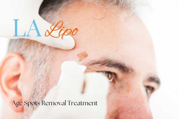 What Are the Most Effective Treatments for Age Spots Lewes?