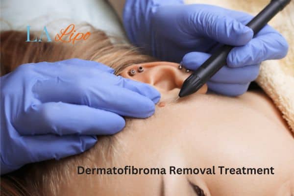 Dermatofibroma Removal Treatment Lewes