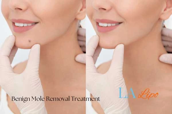 Before-and-after results following benign mole-removal treatment Lewes