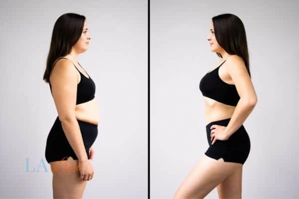 image of woman before and after results of LA-EMS Body Sculpting Lewes to help treat Diastasis recti