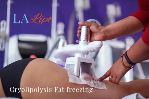 women getting fat freezing Lewes