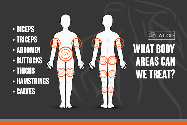 Graphic to show areas you can have LA-EMS Body Sculpting Lewes treatment.
