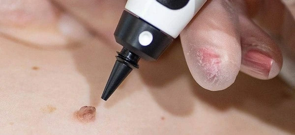 skin tag removal using cryopen Lewes