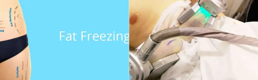 Fat freezing Lewes on multiple areas of the body