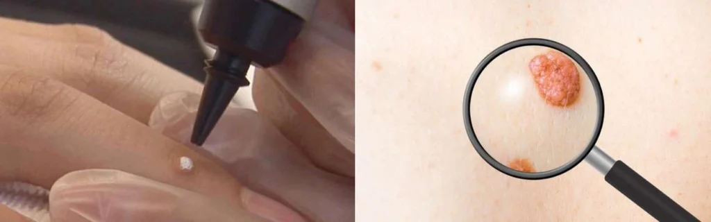 CryoPen practitioner Lewes assessing a benign mole before treatment