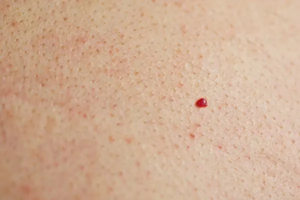 close up of a cherry angioma Lewes