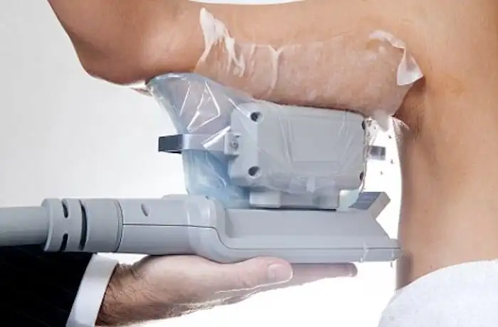 Picture of fat freezing Lewes on the upper arms.