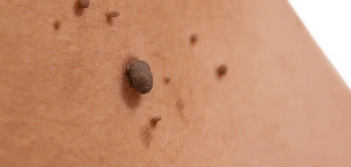 image of a skin tag Lewes