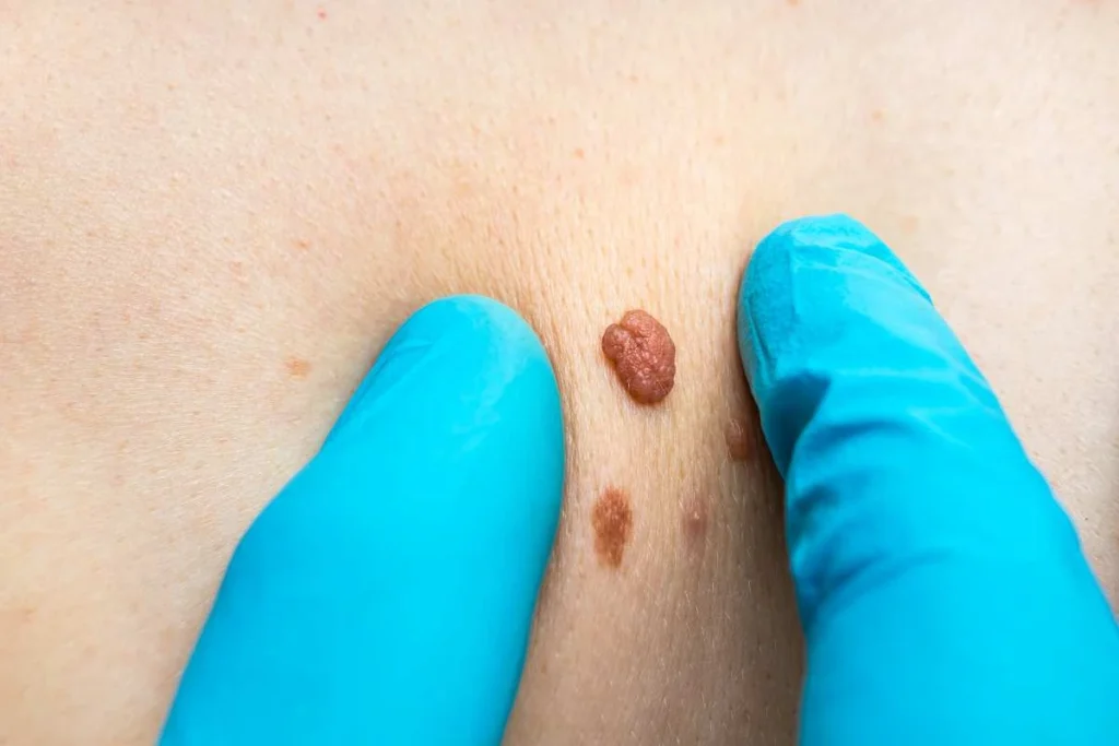 Consultant examining a skin tag Lewes