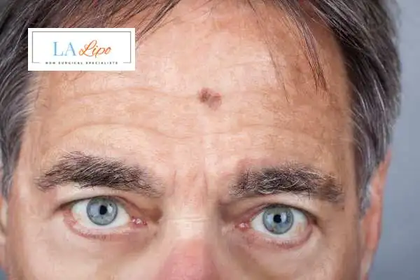 Solar Lentigo Removal Lewes image of man with mark on his forehead