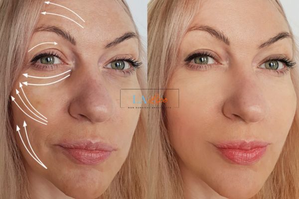 Morpheus 8 results Lewes face lift.