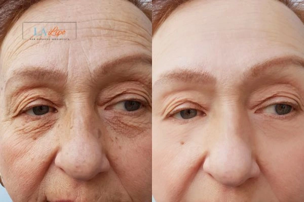 The powerful benefits of Morpheus8 Treatment Lewes - Call Our team today!