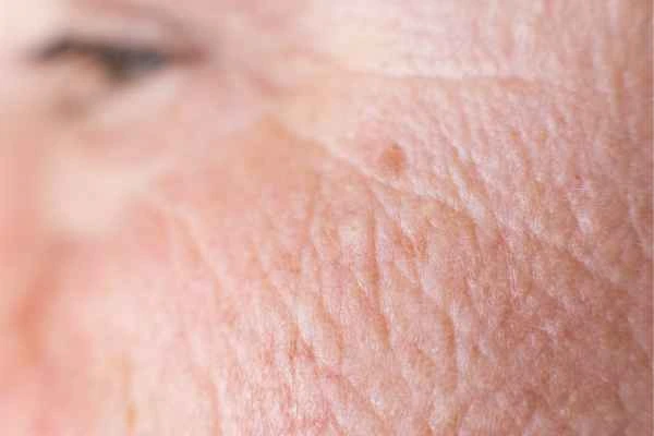 close up picture of a woman's face showing an age spot Lewes