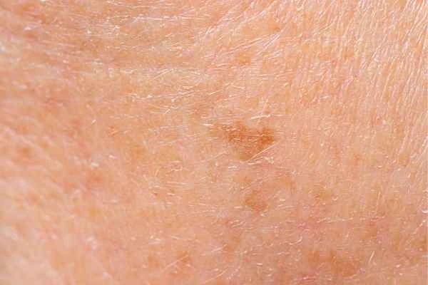 close up picture of age spots Lewes