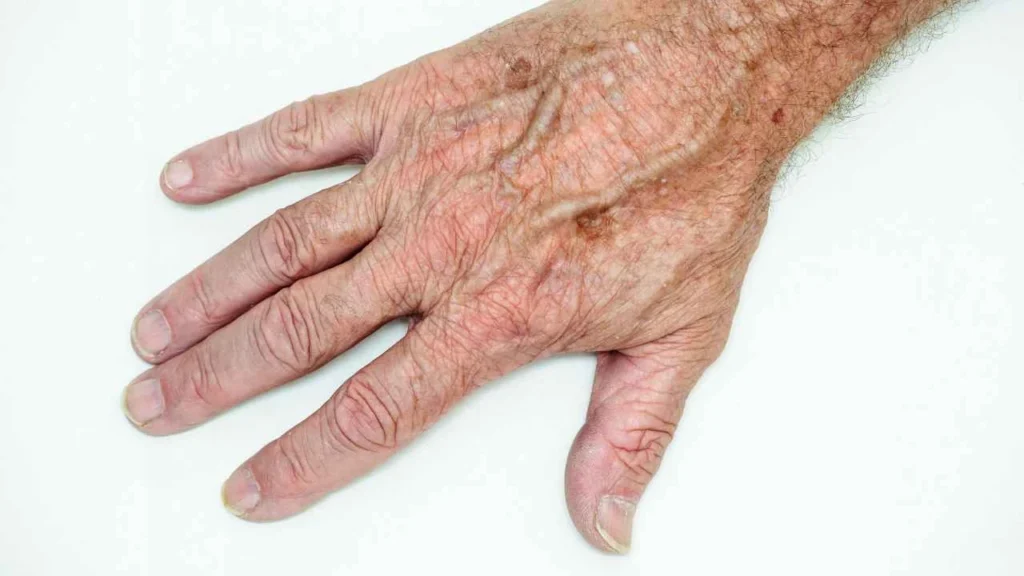 Male hand showing age spot Lewes