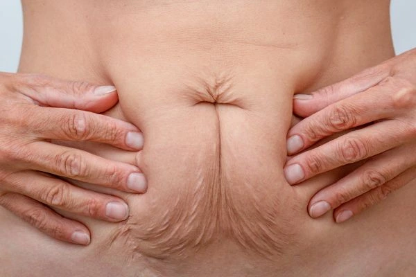 Image of a woman's stomach with loose skin - example of skin tightening Lewes options