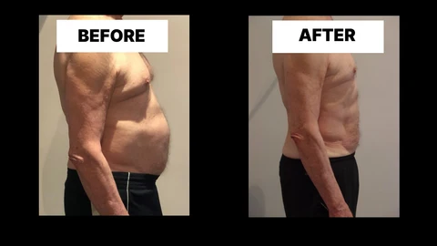 What Symptoms Can Diastasis Recti Cause in Men? Weak Core, Back Pain and Poor Posture Lewes